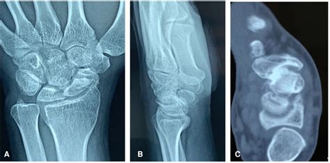 Frontiers Clinical Outcomes Of Double Screw Fixation With Bone Grafting For Displaced Scaphoid