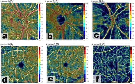 OCT Angiography Images 4 5 4 5 Mm OCTA Optic Disk Head Scans