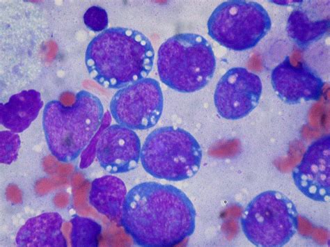 Figure Burkitt Lymphoma Lymphoblasts Contributed By StatPearls