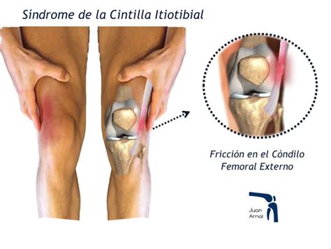 Rodilla Del Corredor Sindrome De La Cintilla Iliotibial Juan Arnal