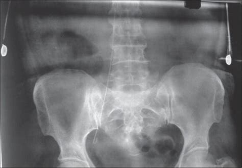 X-ray pelvis showing guide wire catheter had remained in the right ...