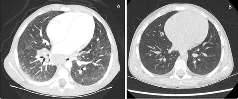 About A Case Of Multisystemic Granulomatous Disease In A 4 Year Old