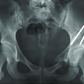 Complications or additional surgery after periacetabular osteotomy ...