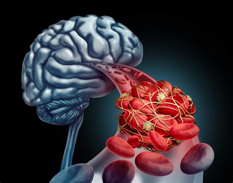 Clean Up Protein May Turn The Tide On Brain Hemorrhage Survival