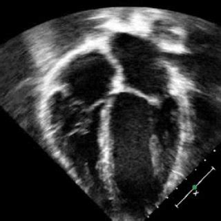 Four Chamber Echocardiographic Image Demonstrating Normal Sized Atria