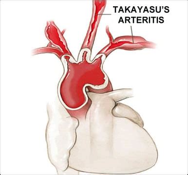 How to Treat Takayasu Arteritis in Ayurveda?