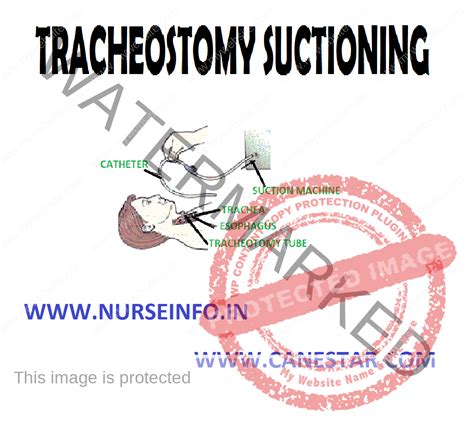 Tracheostomy Suctioning And Care