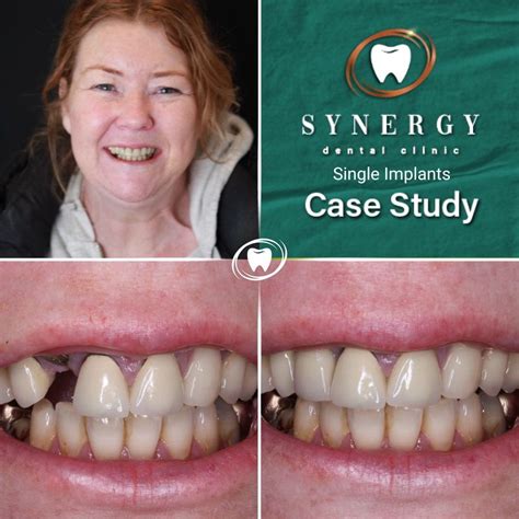 Dr Zuber Bagasi Synergy Blackpool Single Implant • Synergy Dental