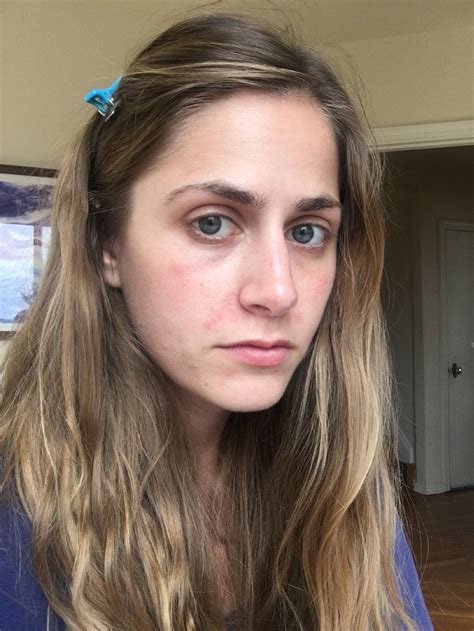 How to Heal Perioral Dermatitis and the Best Products to Use | Who What Wear