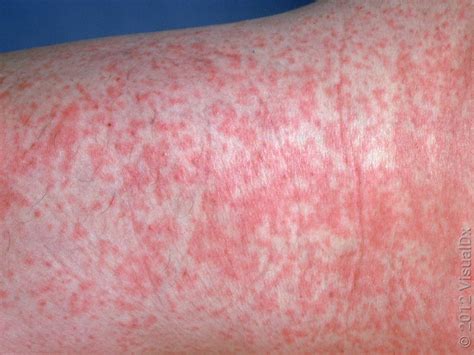 Rubella vs. Rubeola (Measles): Differences, Photos, and More - GoodRx