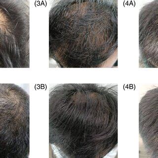 Five patient's photographs of hair regrowth before and after treatment ...