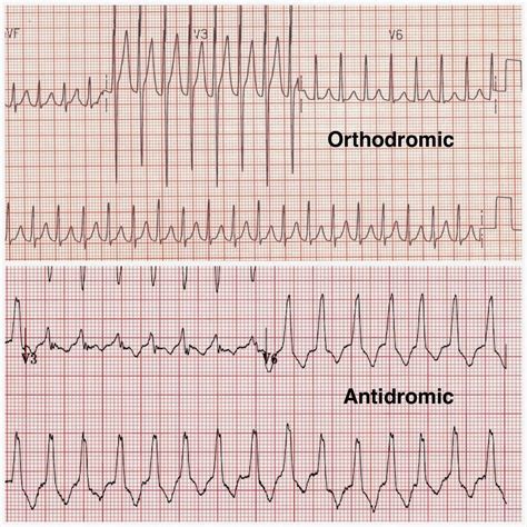 Question about AVRT : Cardiology