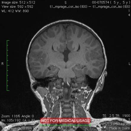 Agenesis of the corpus callosum | Radiology Case | Radiopaedia.org