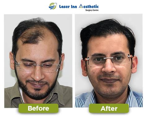 Laser Inn Fue Hair Transplant In Karachi Fue Hair Transplant