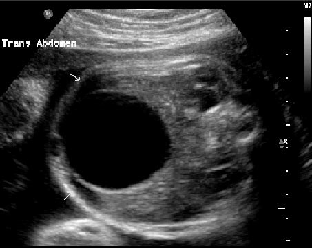 Prenatal ultrasound showing an enlarged fetal bladder. | Download ...