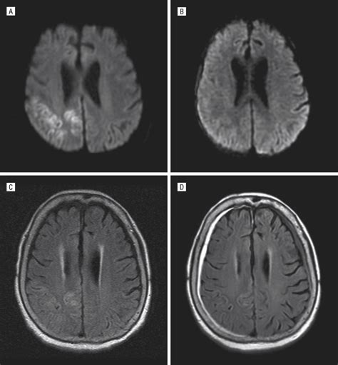 Restricted Diffusion On Magnetic Resonance Imaging In Partial Status