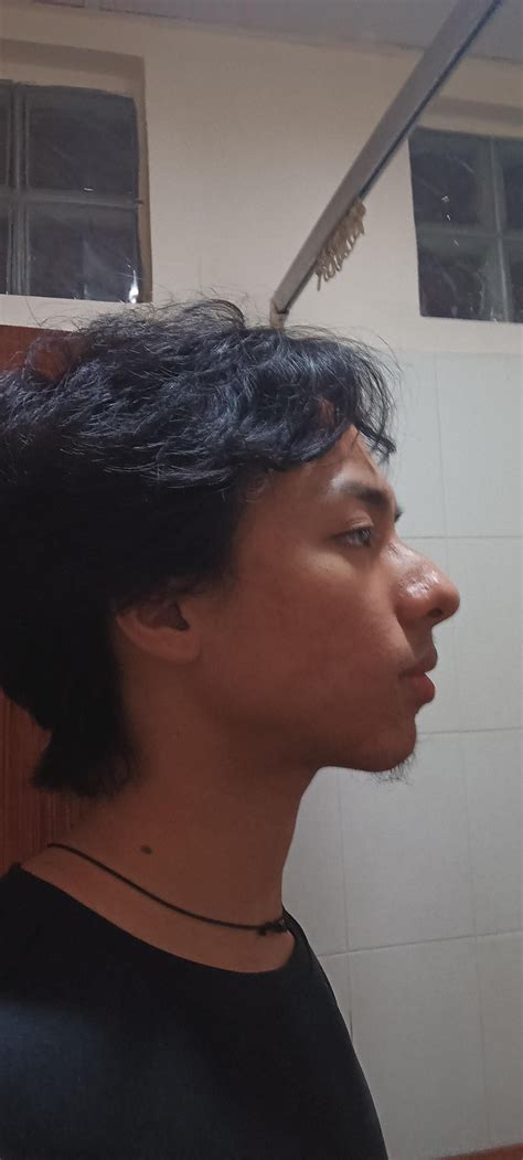 1.5 months of face pulling and chin tucks : r/orthotropics