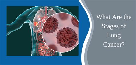 What Are The Stages Of Lung Cancer