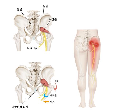 이상근증후군 때문에 골반통증이 심해요 한의원 치료는 어떤가요 인천 임학동 30대중반여 이상근증후군 닥톡 Doctalk