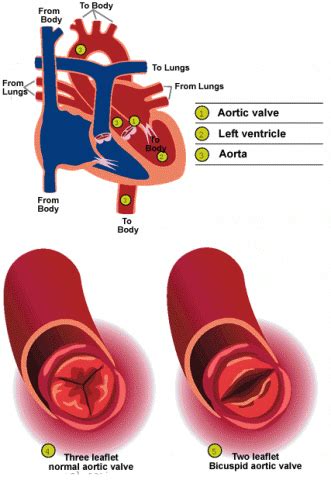 Bicuspid Aortic Valve | CS Mott Children's Hospital | Michigan Medicine