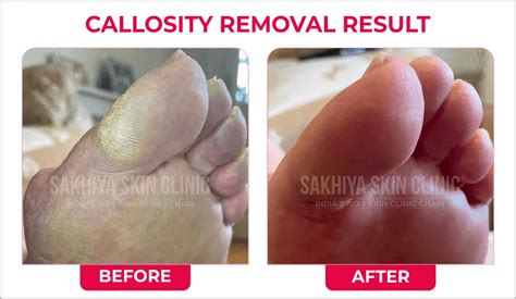 Callosity Removal Treatment Sakhiya Skin Clinic