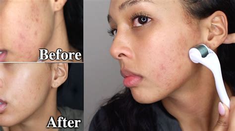 Get Rid Of Acne Scars In 1 Month Microneedling At Home Skin Update Pamela Ross Youtube