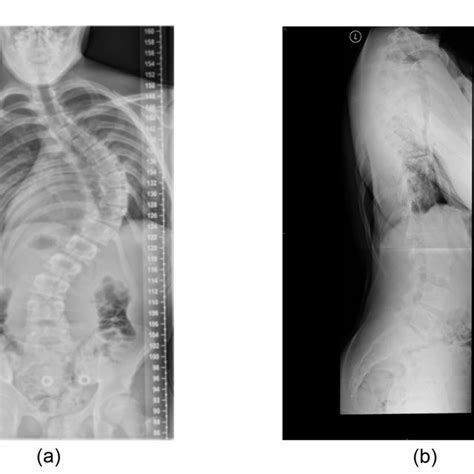 Pdf Adolescent Idiopathic Scoliosis