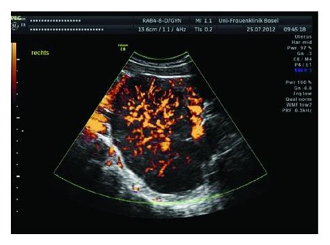 Initial Ovarian Ultrasound Showed Bilateral Ovary Masses Download