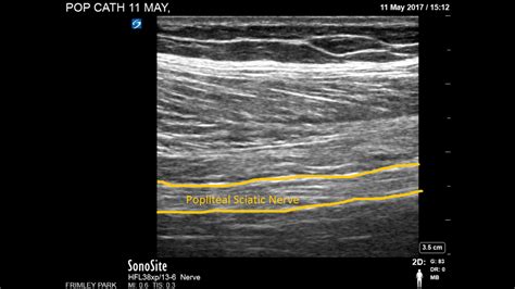 Popliteal Sciatic Block