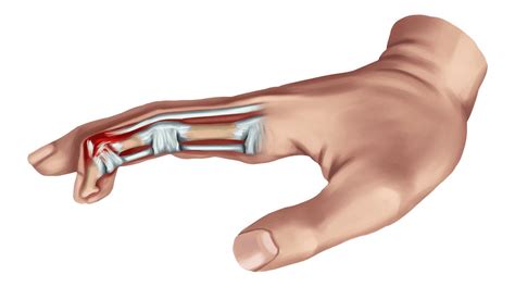 Dedo em Martelo Diagnóstico e Tratamento Dr Pedro Henrique Pires