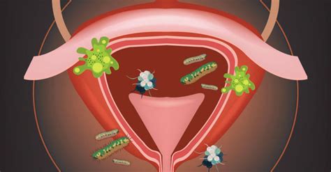 6 síntomas de cistitis y cómo aliviarlos