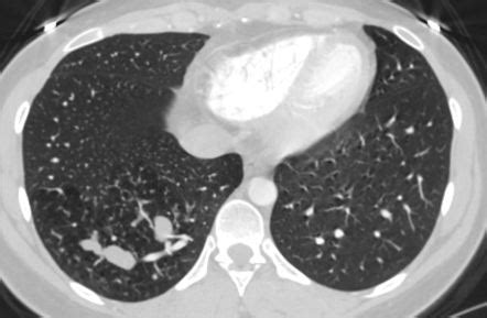 Intralobar Sequestration Radiology Case Radiopaedia Org