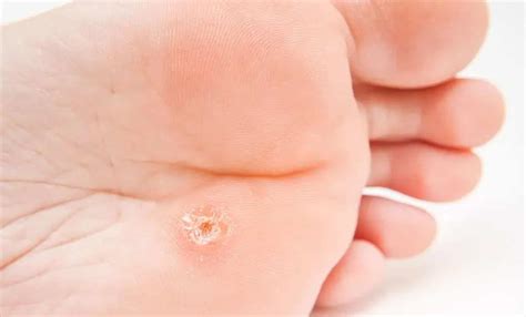 Plantar Warts Solutions Well Heeled Podiatry In Hampton