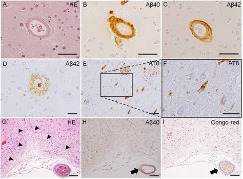 Frontiers Clinical Features And Experimental Models Of Cerebral Small