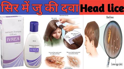 Ivrea Shampoo Ivermectin Shampoo Best Medicine For Head Lice Youtube