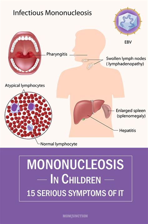 Mononucleosis Symptoms Diagnosis - treesemart