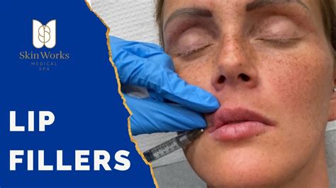 Lip Fillers Juvederm Ultra Ultra Plus Restylane Kysse YouTube