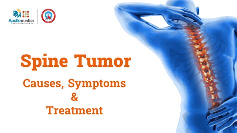 Spine Tumor Symptoms Archives Apollomedics Super Speciality Hospitals