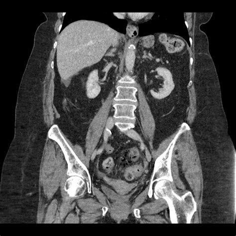 Stercoral Colitis With Perforation Image