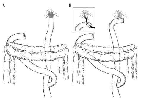 Total Gastrectomy With Roux En Y Esophagojejunostomy