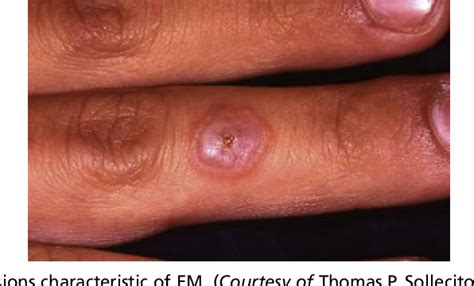 Figure 3 From Erythema Multiforme A Review Of Epidemiology Pathogenesis Clinical Features