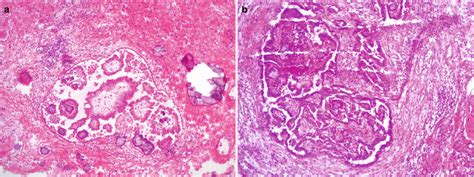 Ovarian Epithelial Tumors Basicmedical Key