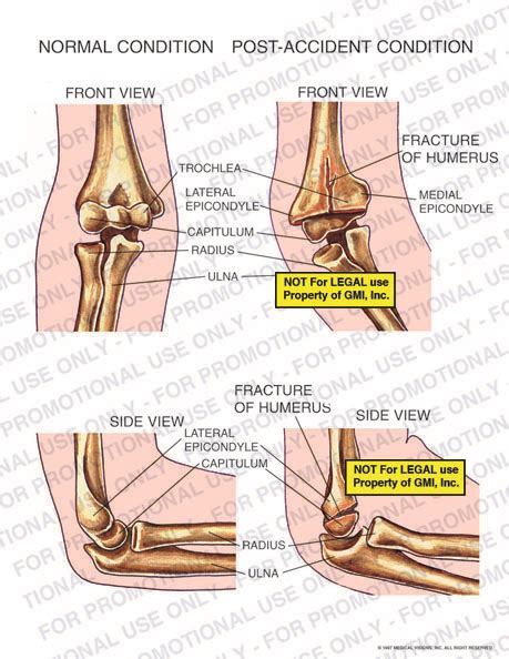 Normal And Post Accident Condition Of Fracture Of Humerus 98012a26b Generic Medical Legal