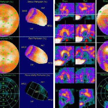 Correlation Between Left Ventricular LV Function And Early Inferior