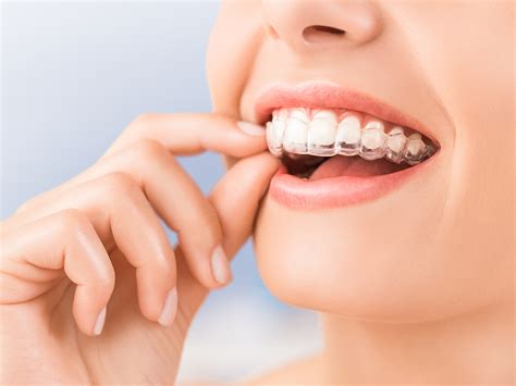 How Long Do Invisalign Impressions Take