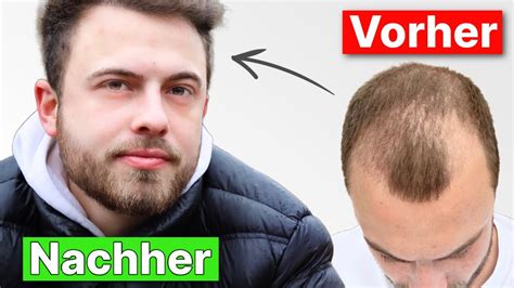 Volle Und Dichte Haare Nach 8 Monaten Tims Haartransplantation