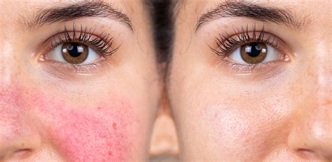 Rosacea Treatments Nyc Dr Amy Wechsler Dermatology