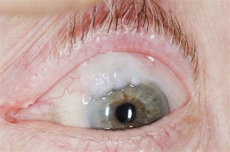 eye bleb  eye surgery stock image  science photo