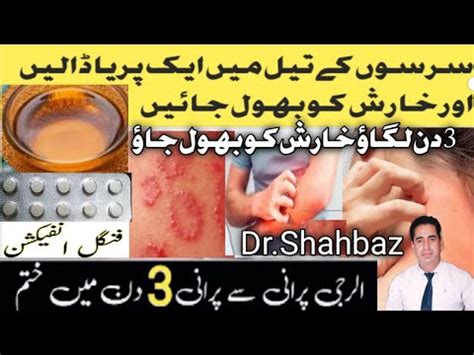 Kharish Ka Fori Ilaj Chambal Ka Ilaj Fungal Infection Treatment In