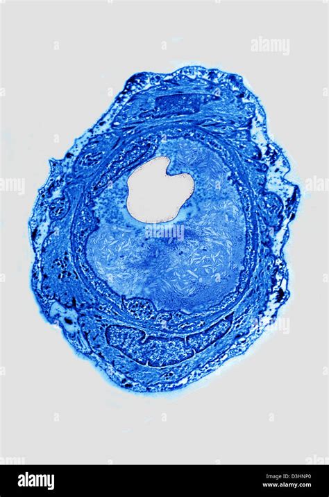 Atheroma histology hi-res stock photography and images - Alamy